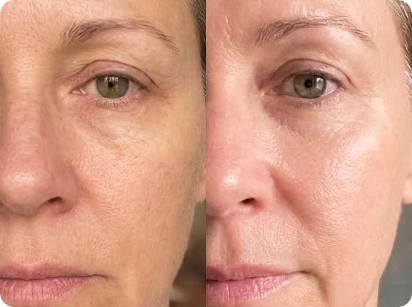 Rachel's result with the salmon PDRN mask