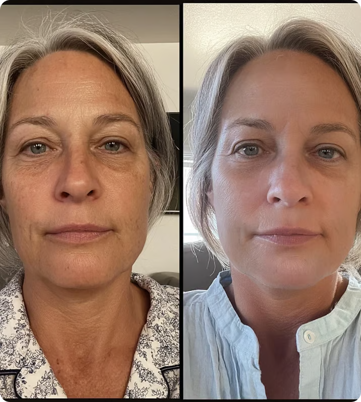 Sophia's result with the salmon PDRN mask