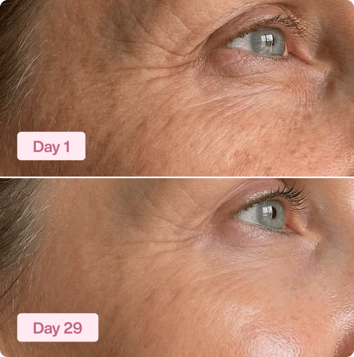 Day 1 versus Day 29 close-up around the eye