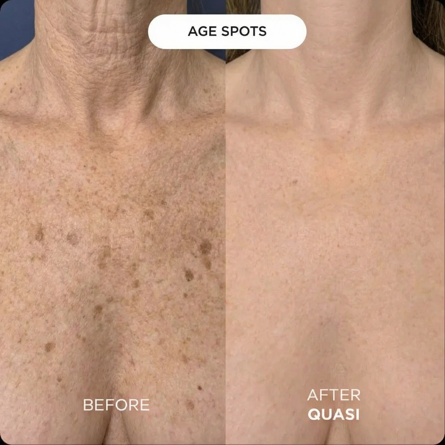 Collagen Chest Mask