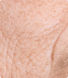 Fine Lines & Wrinkles