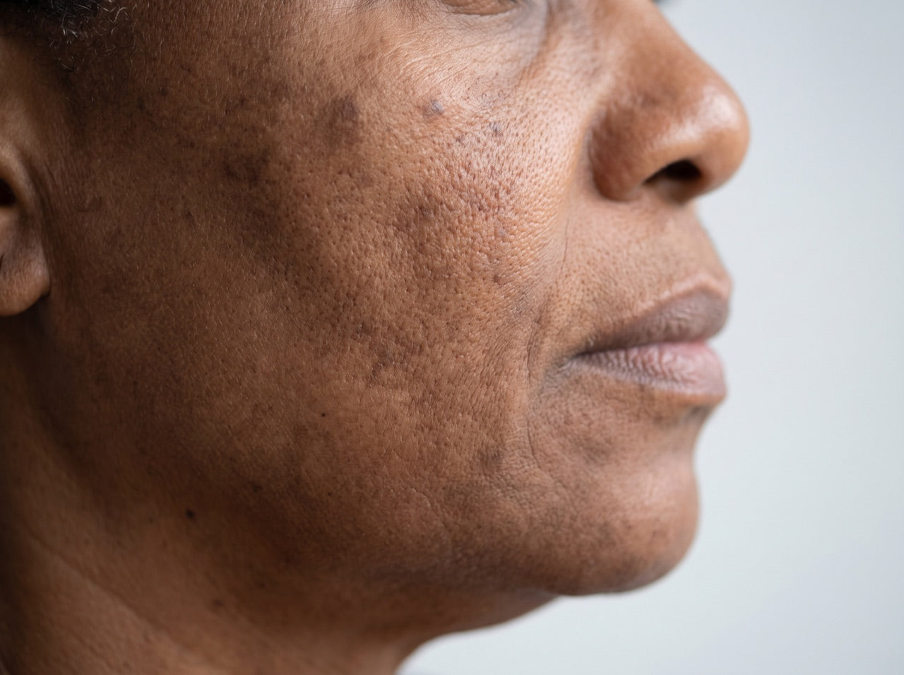 Close-up of melanin-rich skin showing uneven tone and post-inflammatory hyperpigmentation under clinical lighting